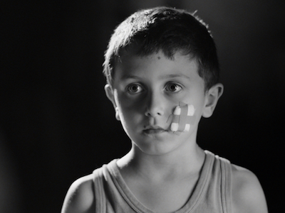 A child with a bandage on their face.